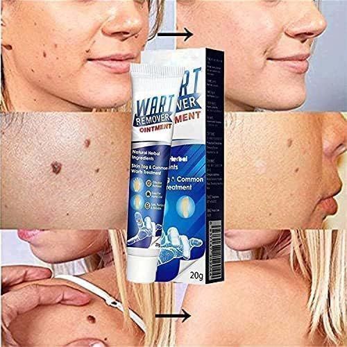Wart Remover Cream